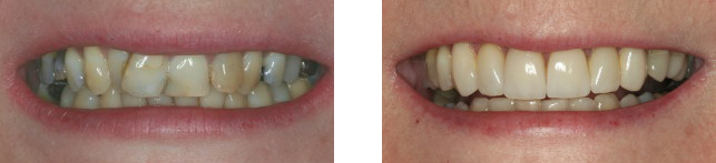 Smile Makeover Veneers