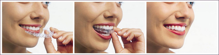 invisalign clear aligners
