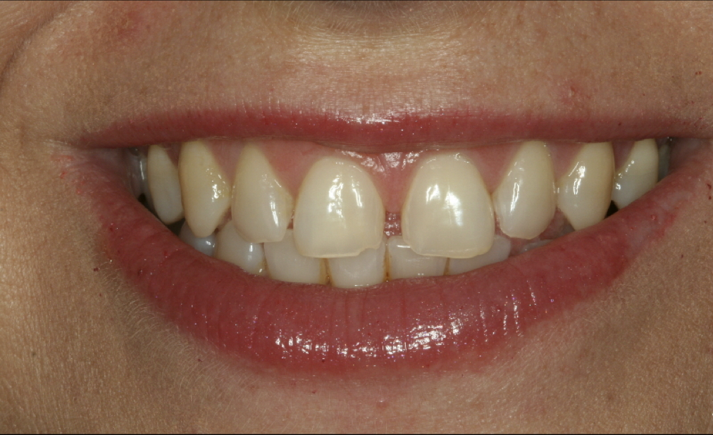 How long do porcelain veneers last? Smile Solutions Article
