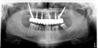 Zygomaticus Implants Zygomaticus Implants