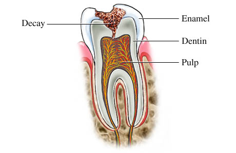 dental decay
