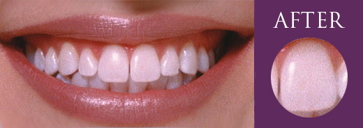 Teeth Whitening Melbourne White White Teeth Whitening Melbourne