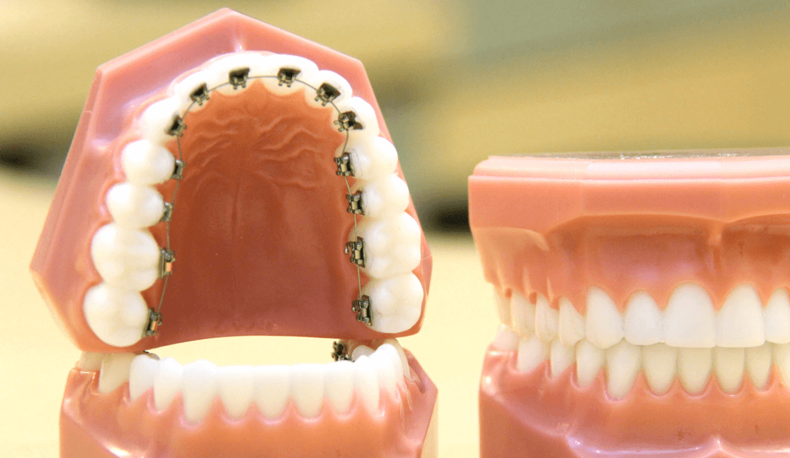 Internal Lingual Braces Melbourne | Orthodontics | Smile Solutions