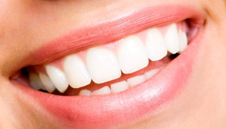 Teeth Whitening Melbourne | Smile Solutions